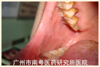 患者女，56岁a.jpg