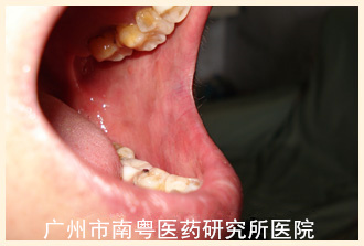 患者女，64岁a.jpg