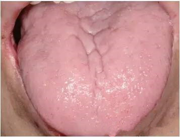 缺铁性贫血患者的舌黏膜表现.jpg
