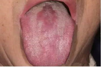 口腔念珠菌病感染，舌乳头萎缩或消失.jpg