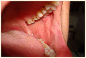 朱先生治疗后的口腔内壁.jpg