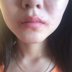 婉婷治疗前.jpg