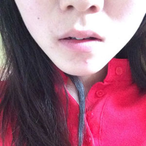 婉婷治疗后.jpg